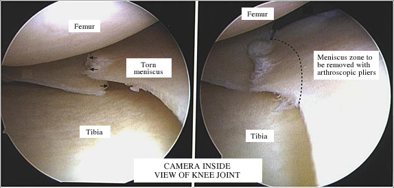 Torn meniscus (Meniscus tear) Bone & Joint Surgery