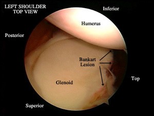 Lesion-Bankart