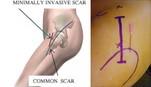 doc1-incisions-comparees