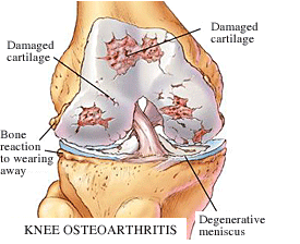 CONVENTIONAL BELOW-KNEE PROSTHESIS MADE OF PLASTIC MATERIAL